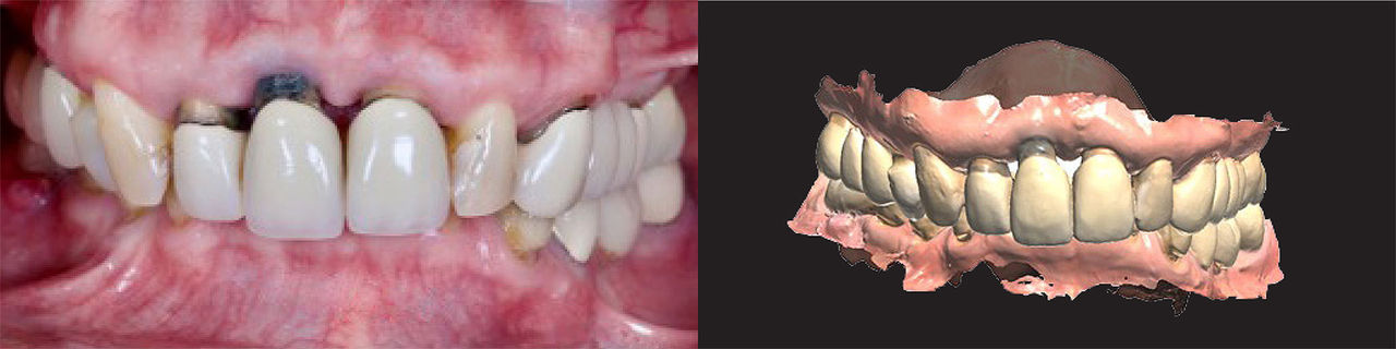 Example of a physical photo and scan for verification of bite