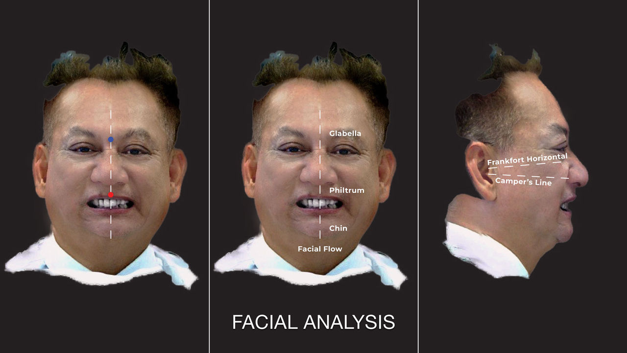 Dental avatar created through facial photos and scans
