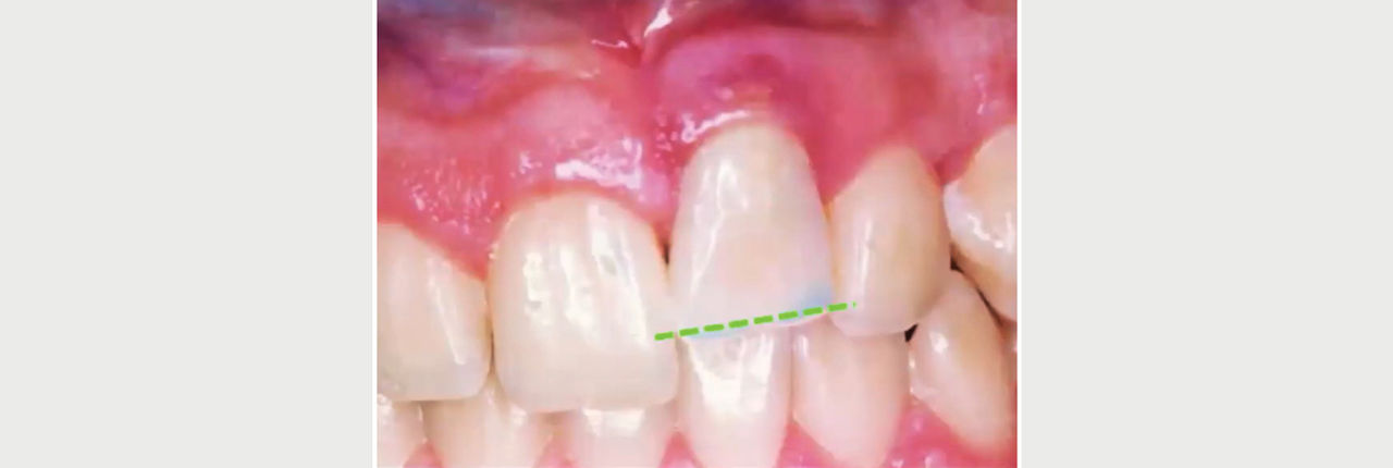 Implant-supported restorations represent one of the most predictable and effective treatment