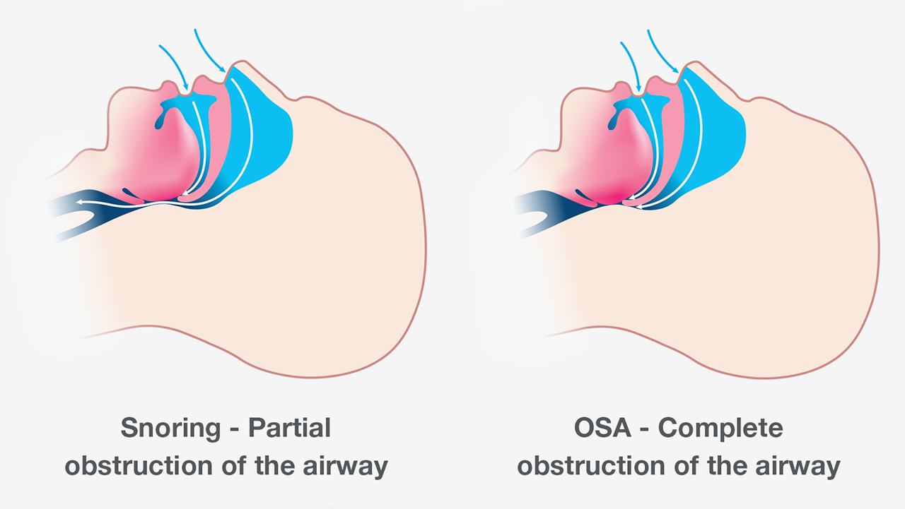 Snoring and OSA obstruction of the airway