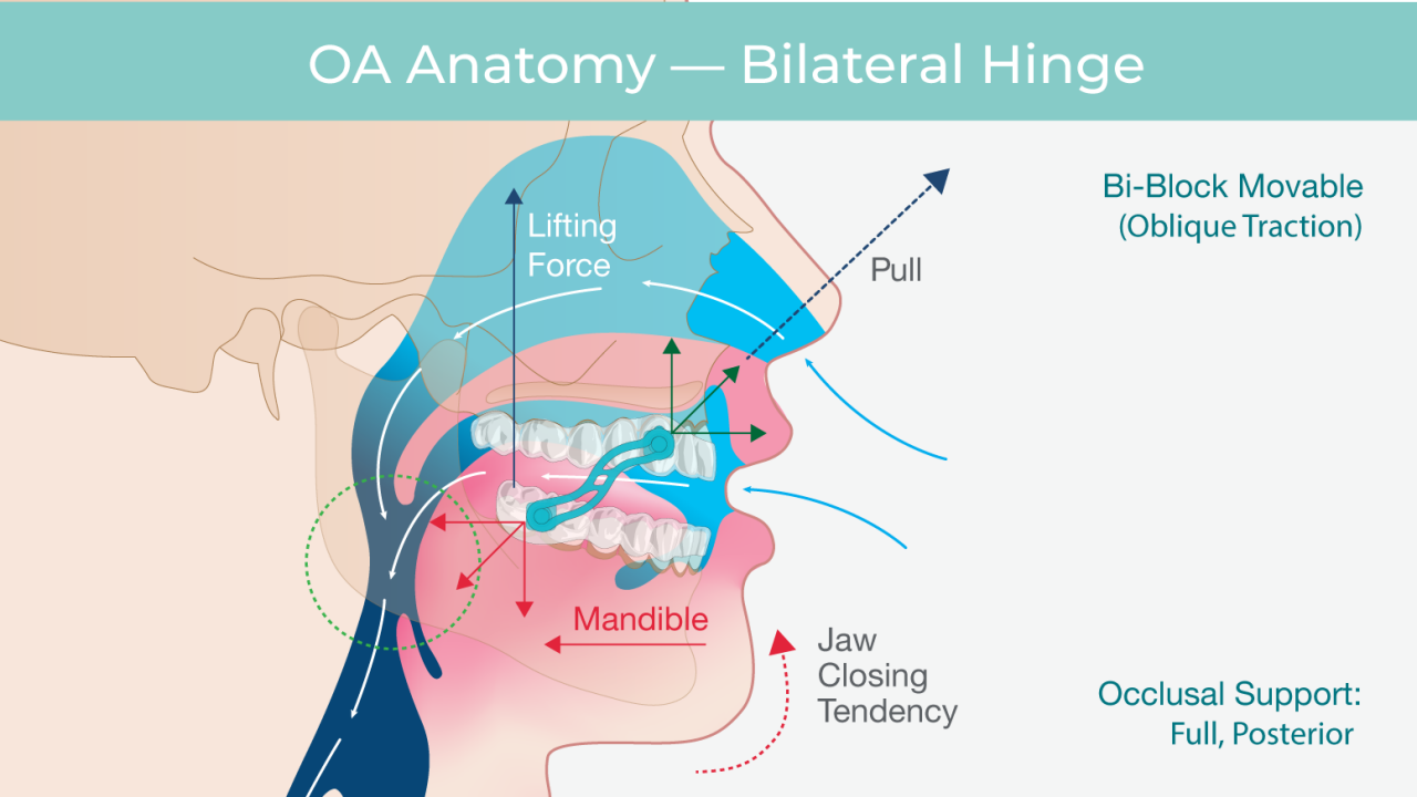 silent nite bilateral hinge infographic