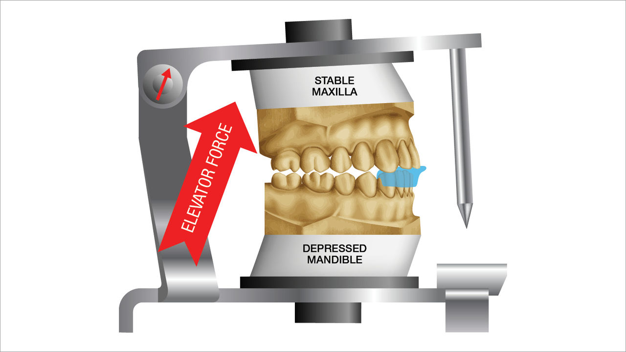 Articulators, commonly used to help dentists understand the movements of the TMJ, do not accurately reflect the condyle-to-fossa relationship and can result in dentists misinterpreting the NTI as a device that could cause distalization of the condyle. 