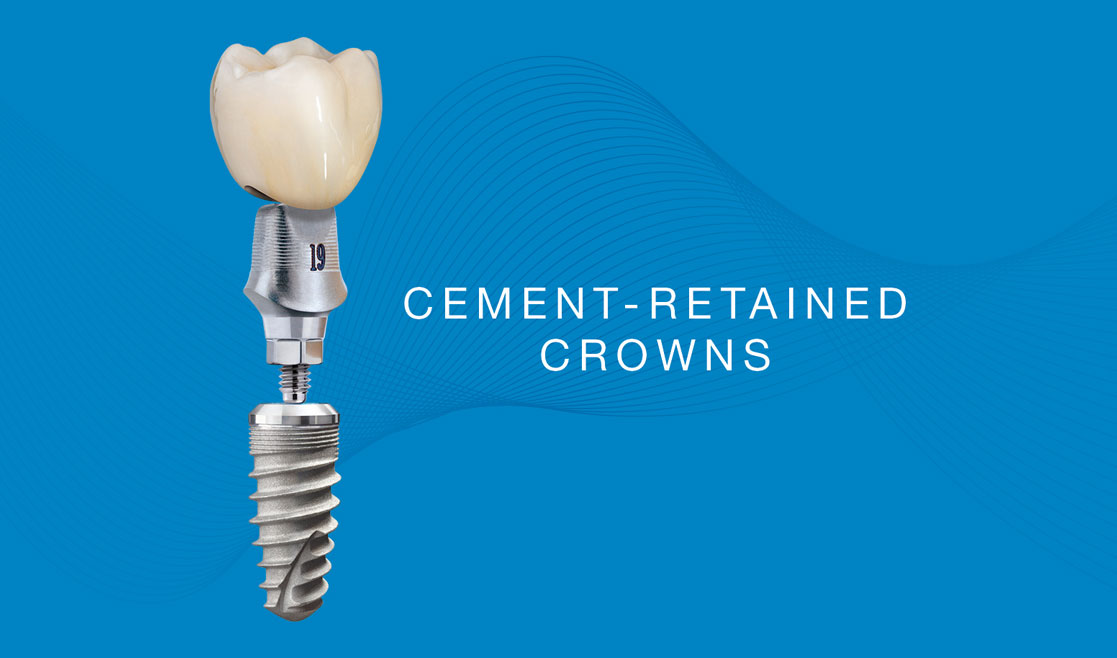 Cement-Retained Implant Crown