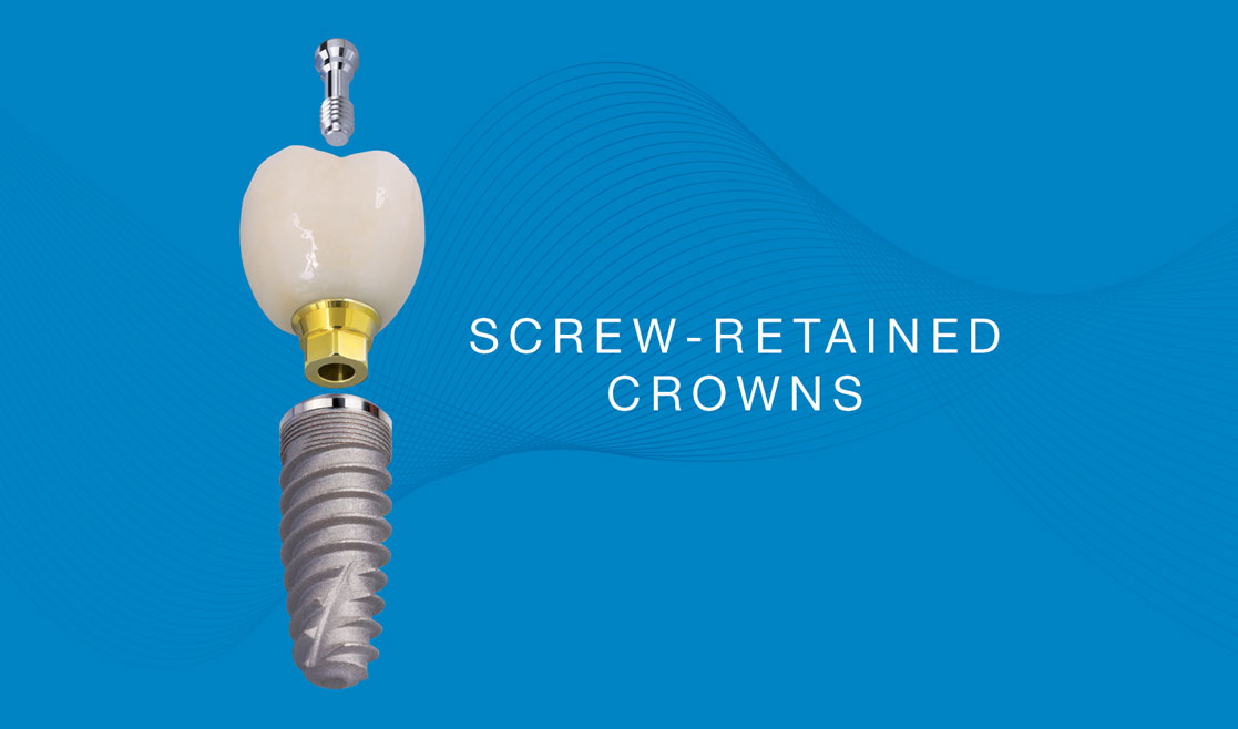 Screw-Retained Implant Crown