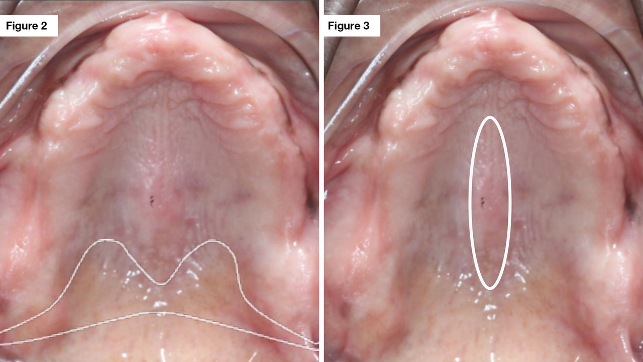 Figure 2: Outline of the posterior palatal seal. Figure 3: Outline of the median palatine suture.