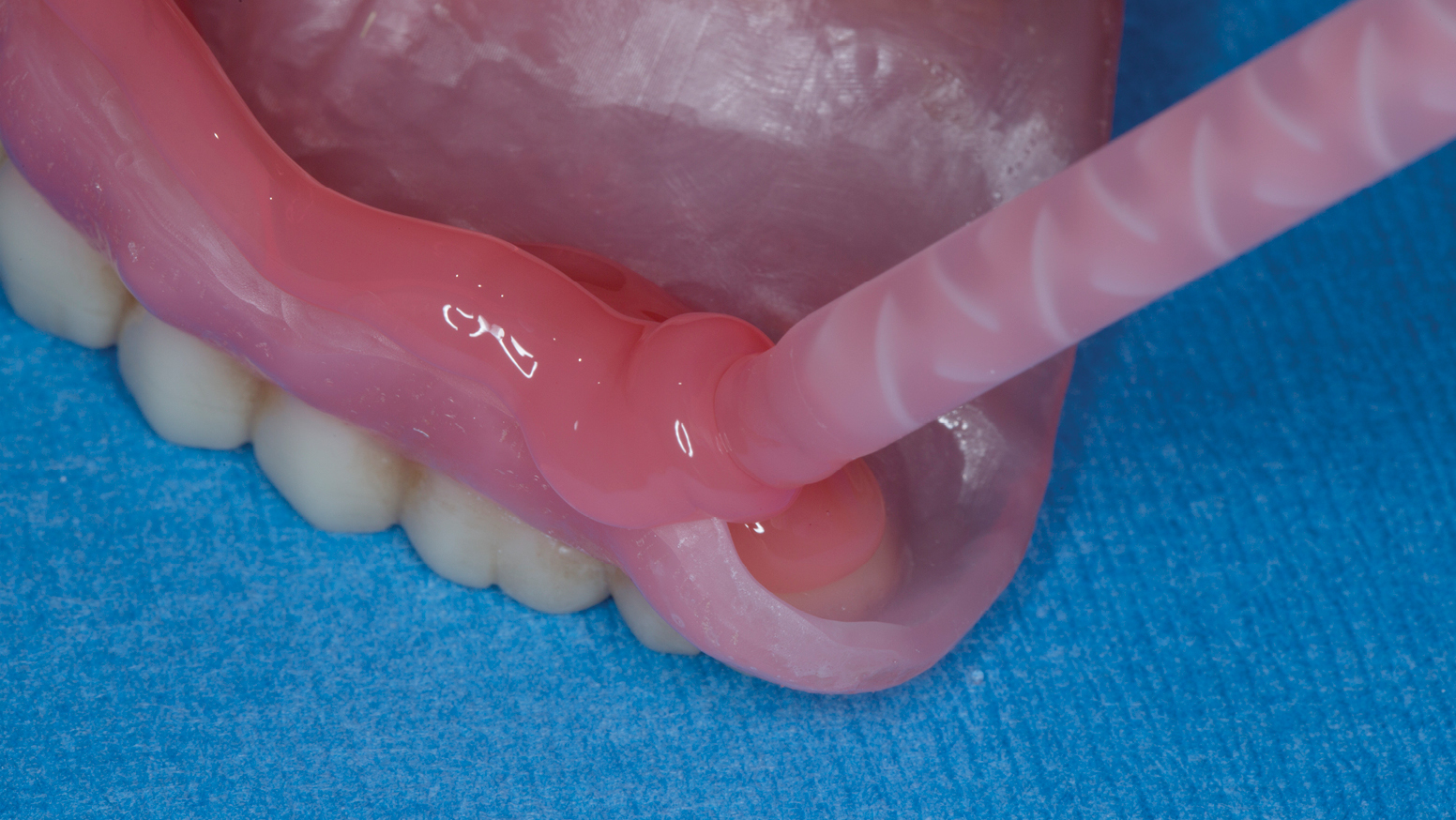 3DPrinted Immediate Dentures Advantages Explained