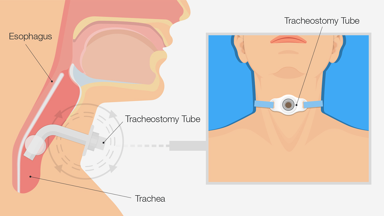 Tracheostomy involves a small incision through the neck into the trachea