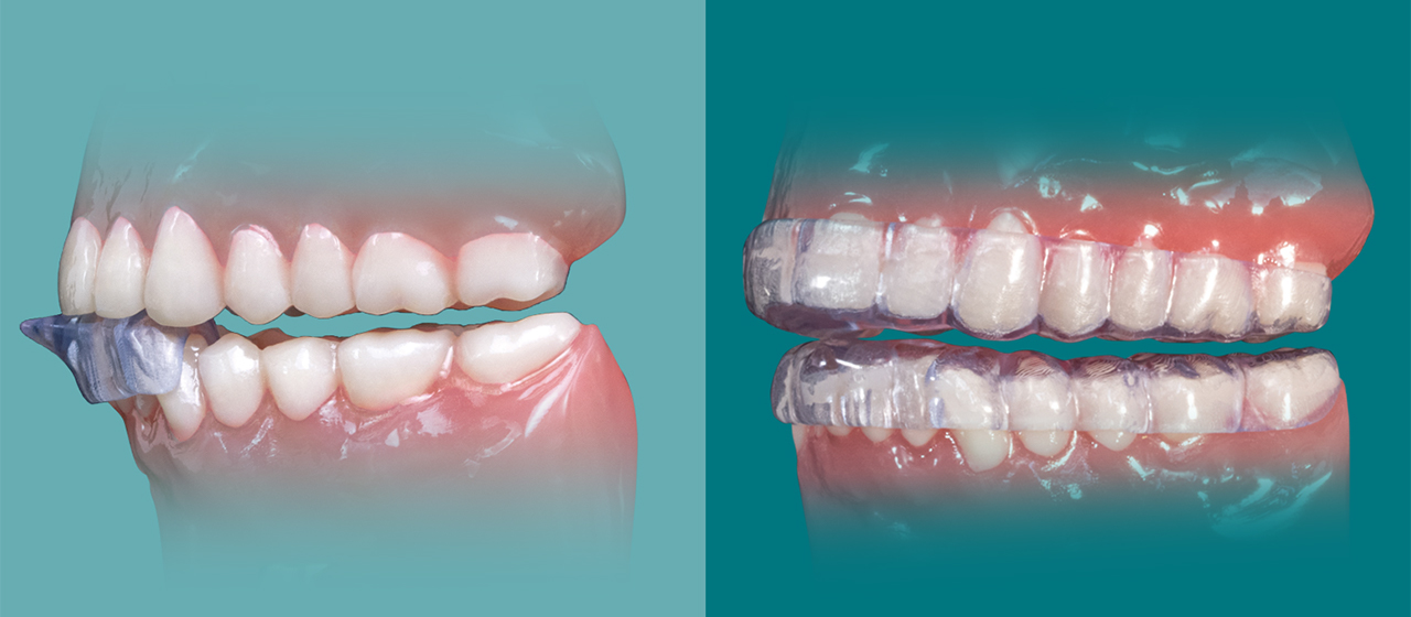 NTI-tss Plus and the NTI OmniSplint product images