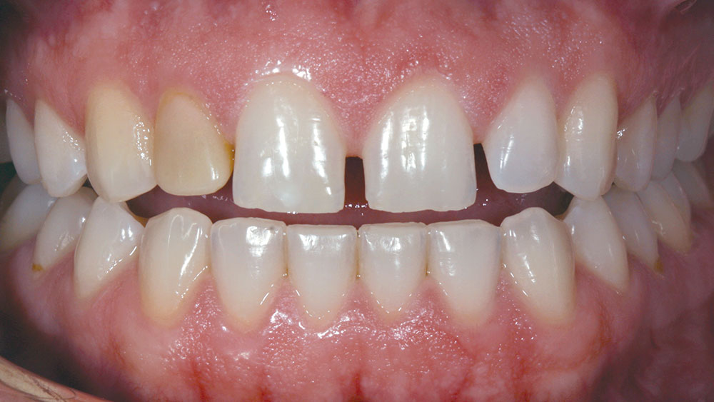 35-year-old male teeth prior to procedure
