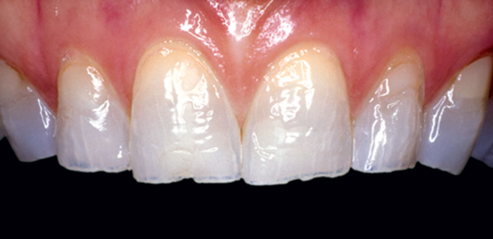 51-year-old female patient with excessive wear on incisal edges of anterior teeth
