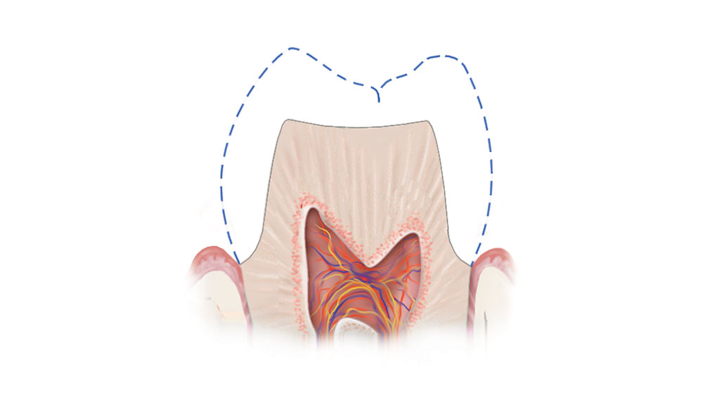 Illustration of internal tooth