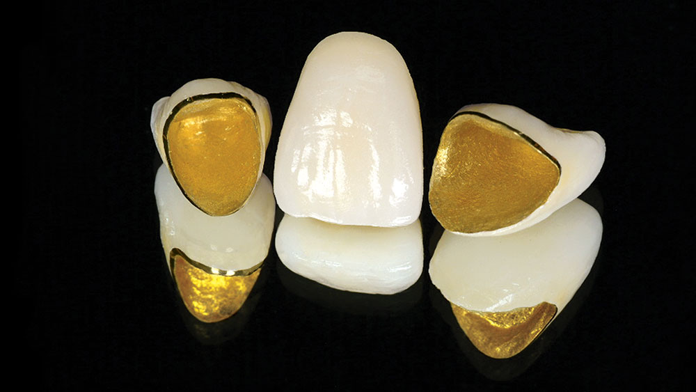 CAD/CAM Porcelain Fused to Captek