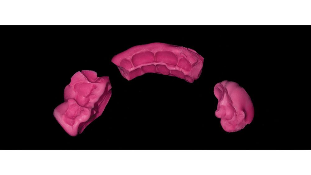 Clinician Spotlight: Occlusal Splints