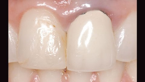 Factors Impacting Long-Term Success of Endodontic Post Systems: The ...