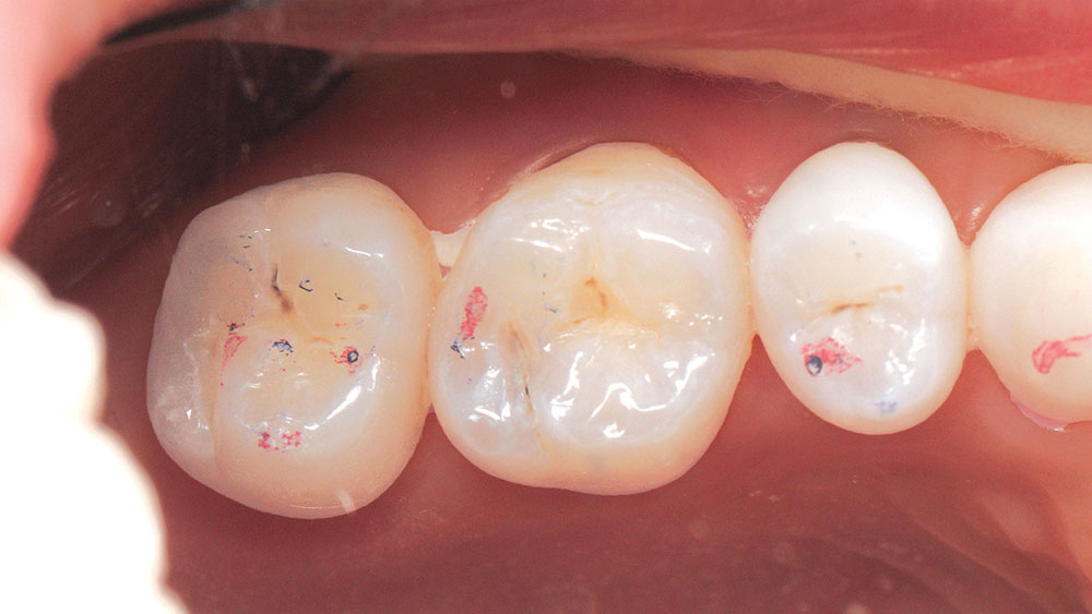 Figure 4: Maxillary molar associated to occlusal trauma