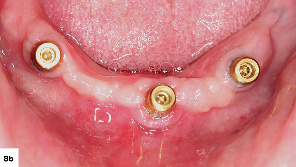 practitioners have the flexibility of placing two implants or more in the edentulous mandible. All three of these cases are shown with Locator abutments in place, which engage with the retentive caps of the overdenture to stabilize the prosthesis image