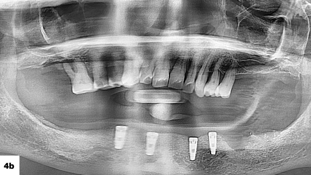 Panoramic radiography was used to assess the vertical bone quantity available to position implants for this patient, who presented with severe periodontal issues and nonrestorable dentition image
