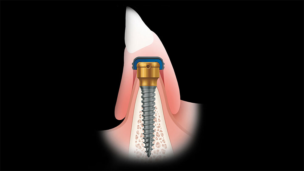 The Locator system holds the overdenture in place via retentive caps embedded in the denture that affix to the specially designed Locator attachment image