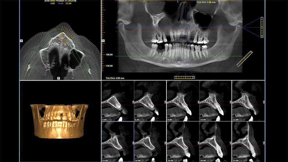 Example of CBCT scanning being used to assess anatomical structures and bone volume of a patient with nonrestorable dentition image