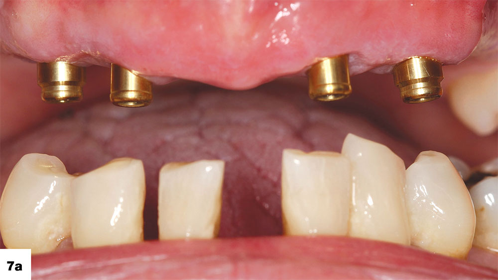 Locator attachments are nearly parallel along the axial plane, allowing for a passive fit of the prosthesis image