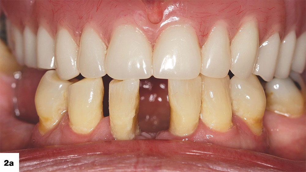 Maxillary implant overdentures can be created with a palateless design image