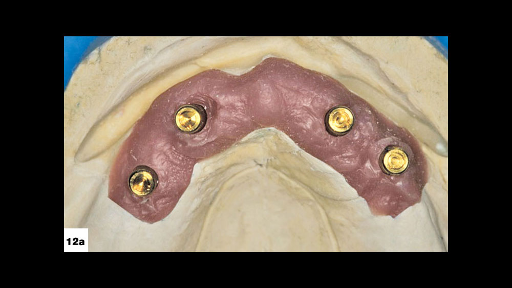The Locator abutments are transferred from the master cast to the patient’s mouth prior to seating the wax rim and setup image