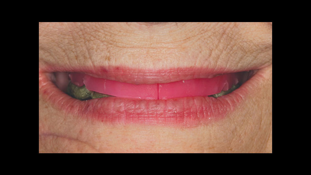  Conventional denture techniques are used to record the jaw relationship information needed to produce an implant overdenture image