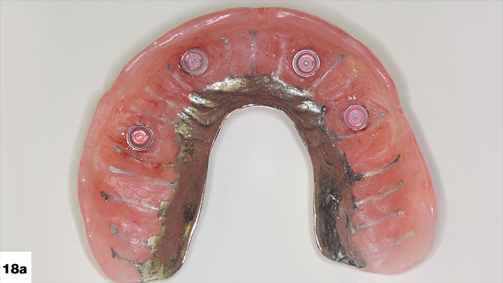 dual arch overdenture case, the black processing caps were replaced with pink retention caps image