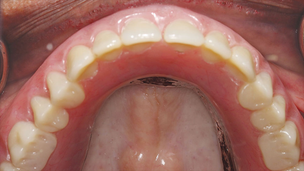  Final implant overdenture being tried in over Locator abutments image