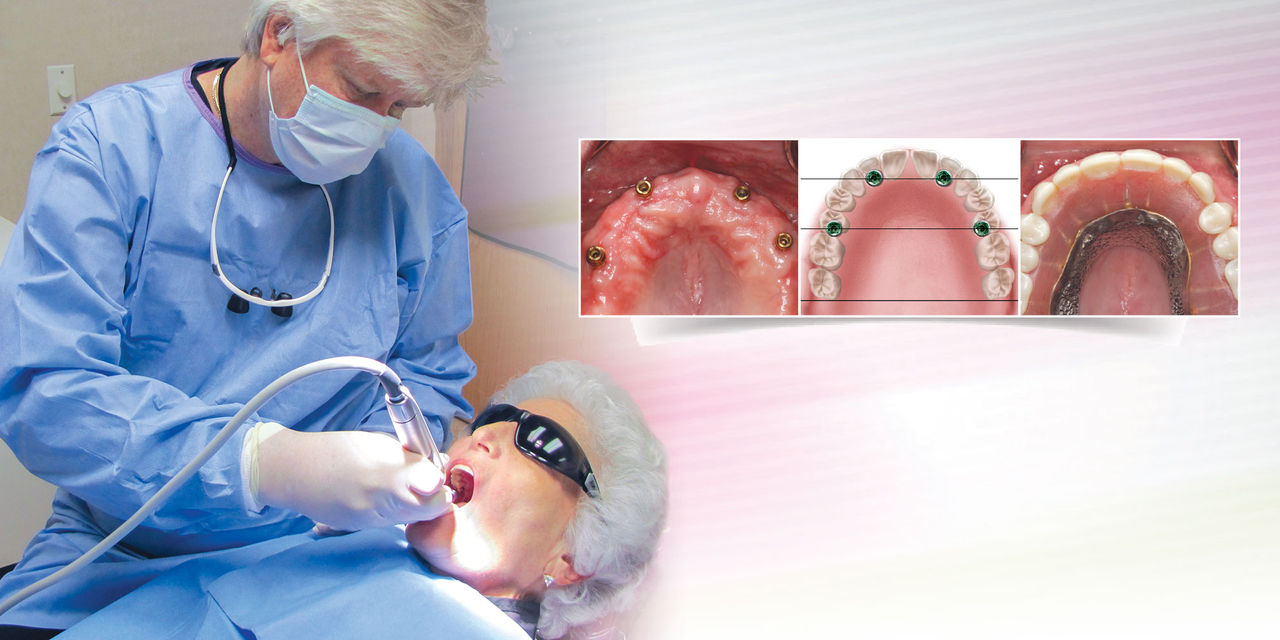 Implant Overdentures: A Superior, Cost-Effective Alternative to Traditional Dentures Hero Image