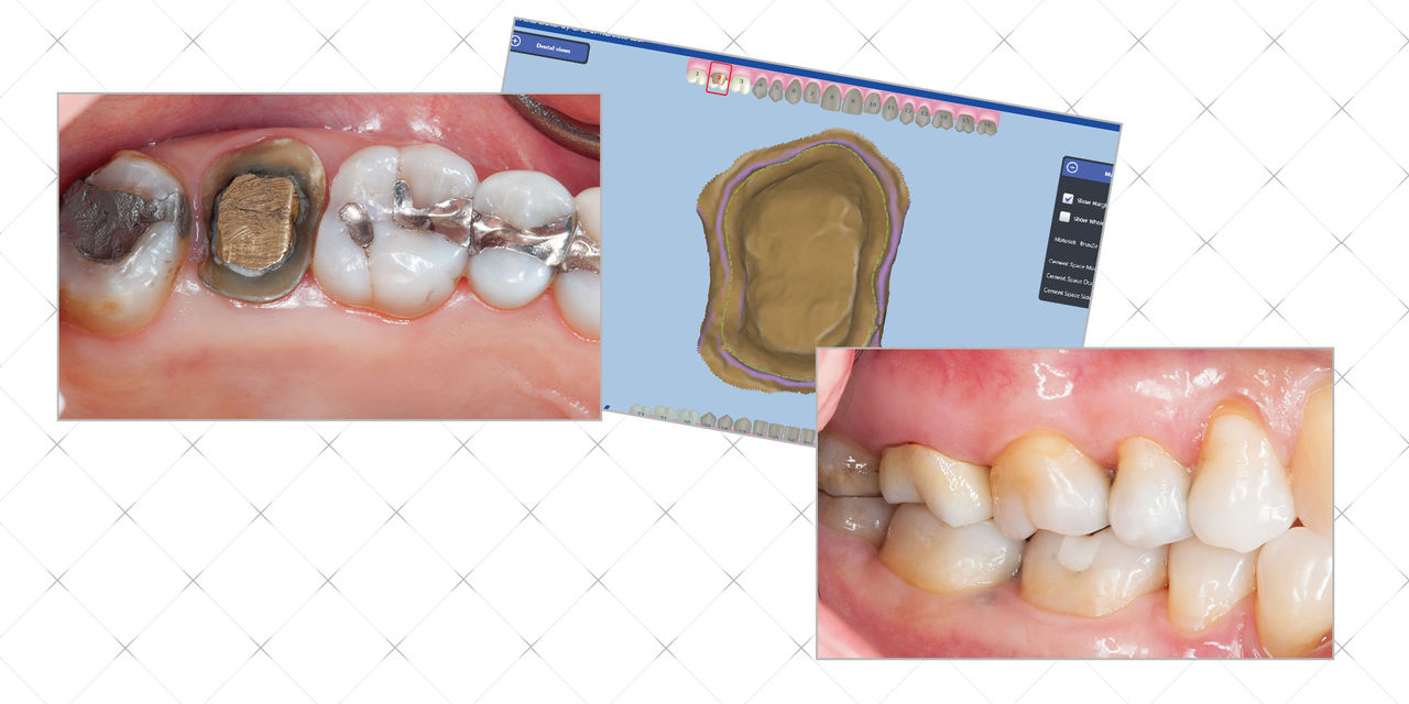 Photo Essay: Making Clear-Cut Cases Even Simpler with In-Office BruxZir® Solid Zirconia Image