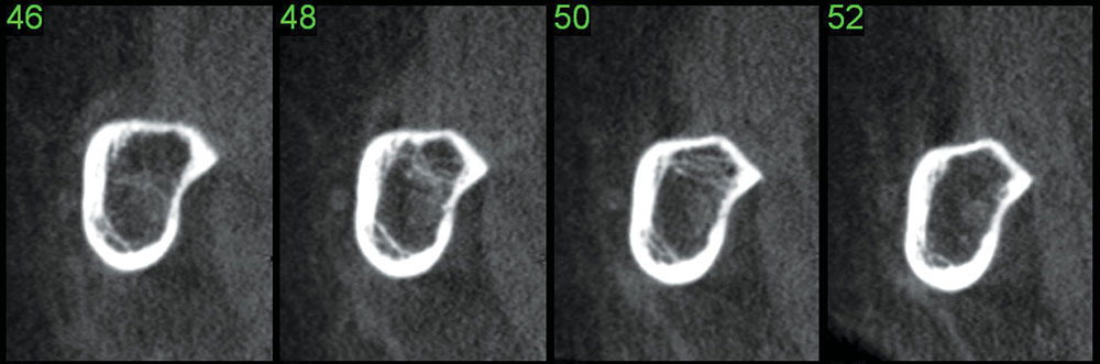 Cone-beam computed tomography can be utilized to visualize the sharp mylohyoid ridge of a patient. The cross-sectional slices individually reveal the clinical situation and can be beneficial in dentist-to-patient communication prior to treatment image