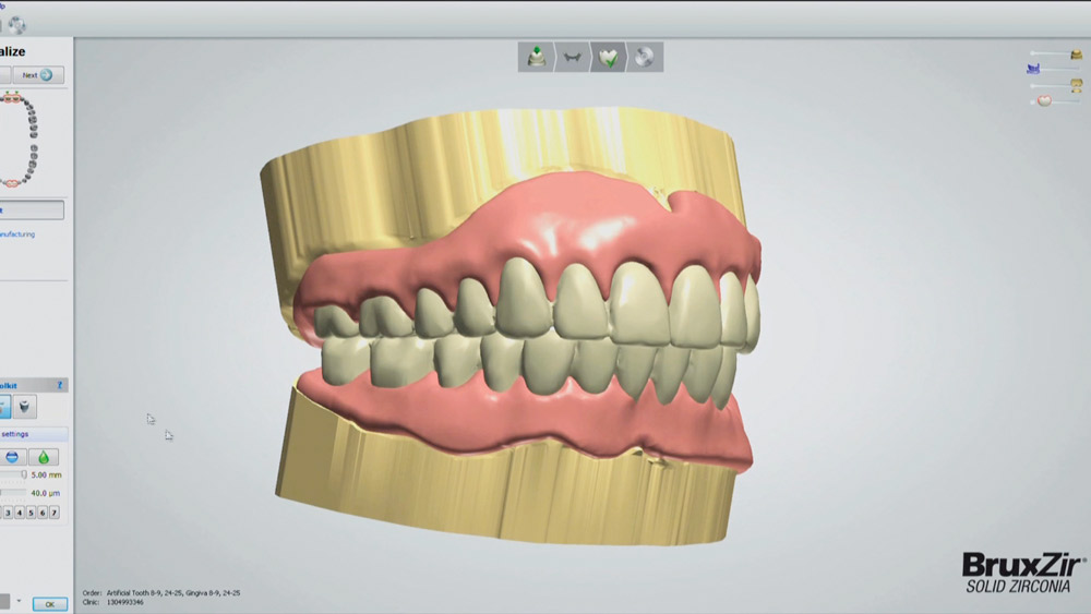 Figure 2 Digital dentures