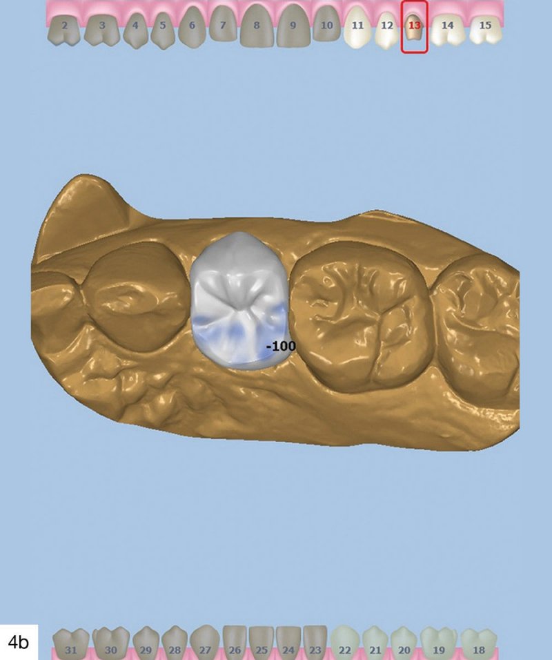 New Innovations in Chairside Milling of Solid Zirconia Crowns