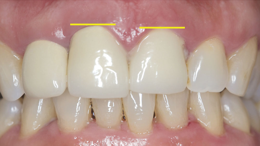 Figure 2: The gingival disharmony is an issue I will attempt to correct with a laser.
