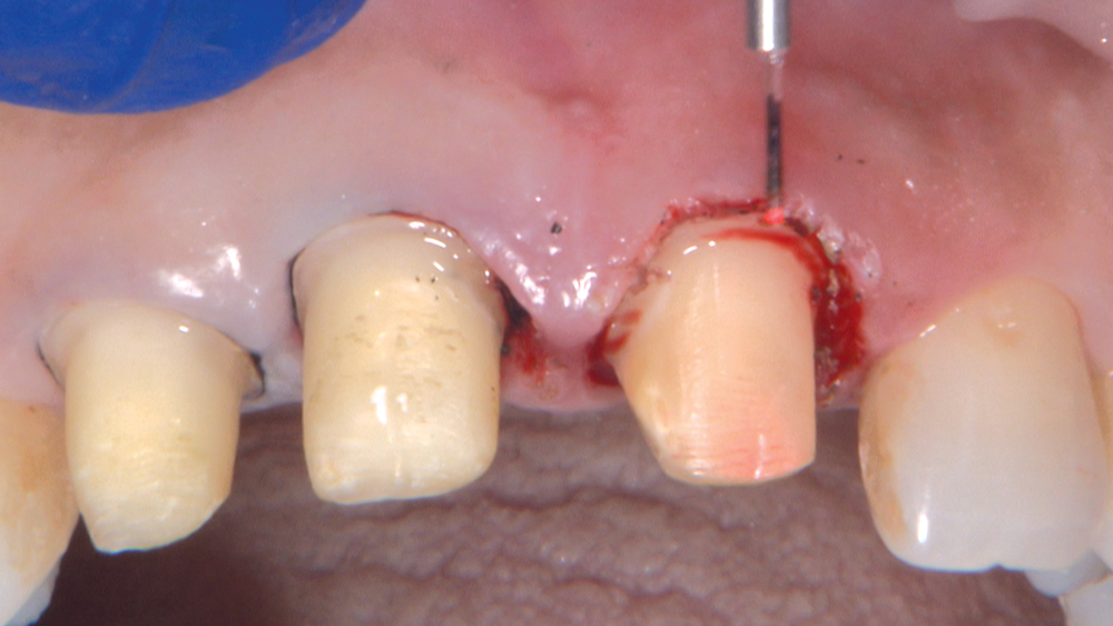 Figures 10b: I employ a diamond bur from Axis Dental (Coppell, Texas) to smooth the margin, and then I use the laser to bevel the gingiva. Note how the lacerated tissue has been excised. I’m not going to make my impression at this time; rather, I will temporize and let the tissue heal for about two weeks.