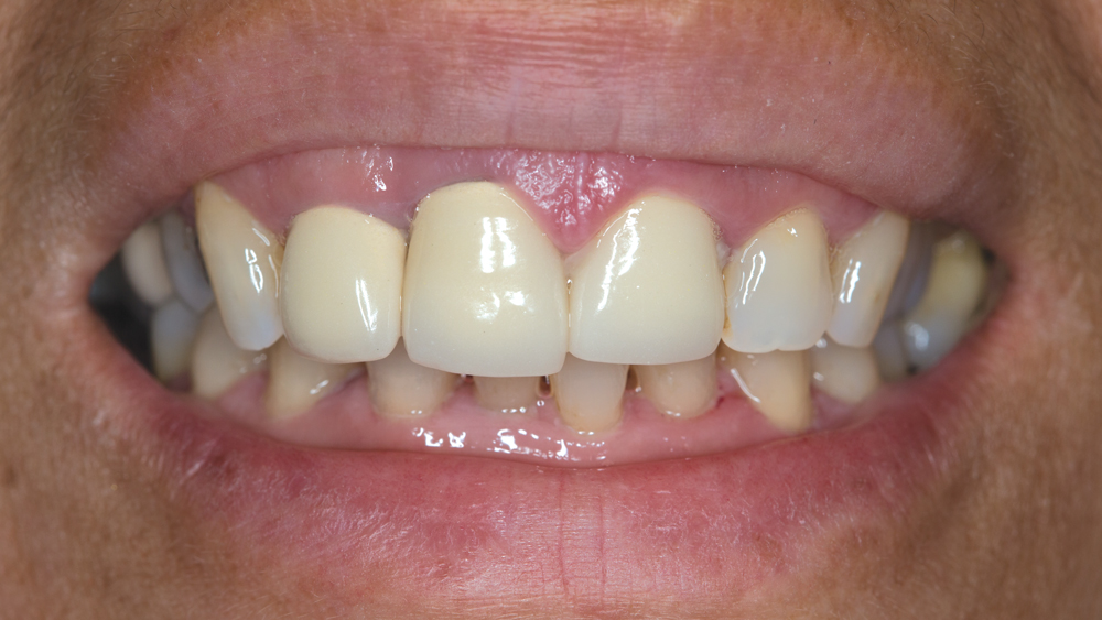 Figure 1: The patient presents with PFM crowns that have been in place for a few years. Note the gingival recession around tooth #8 and the low value around the margin. We can also see gingival inflammation, especially around tooth #9.