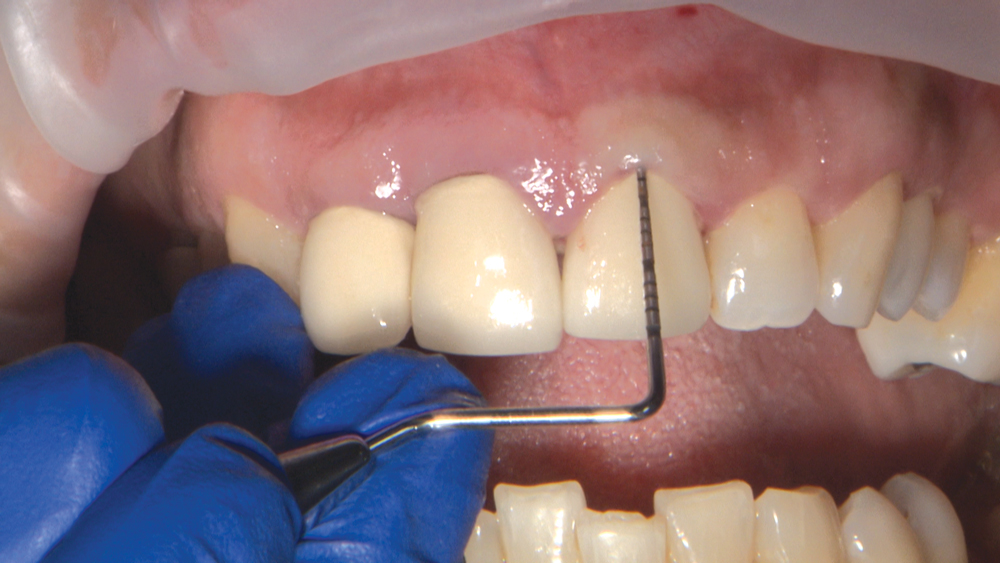 Figures 3a: I want to examine the patient’s gingival tissue thickness. A periodontal probe placed into the sulcus with no gingival show-through demonstrates that this patient has a thick gingival biotype.