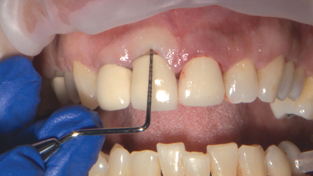 Figures 3b: I want to examine the patient’s gingival tissue thickness. A periodontal probe placed into the sulcus with no gingival show-through demonstrates that this patient has a thick gingival biotype.