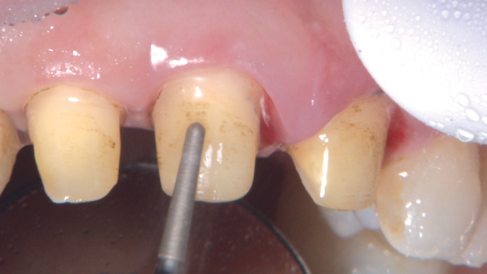 Figure 6: There is some staining on tooth #7 where there was an open margin, but a reasonable amount of tooth structure remains and there is no decay. Because the dentin color of these preps is not dark, I select BruxZir Anterior for the final restoration. The high light transmission value of BruxZir Anterior enables a lifelike, translucent look; however, very dark dentin discoloration may show through in some cases.