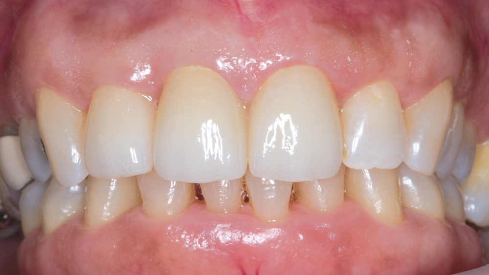 Figure 22: Looking at the gingiva post-cementation, the esthetics are much improved. Gingivectomy was completed with a laser and care was taken to not impinge on the biological width. The marginal accuracy of the BruxZir Anterior material contributed to the biological integration of the restorations into the gingival tissue.