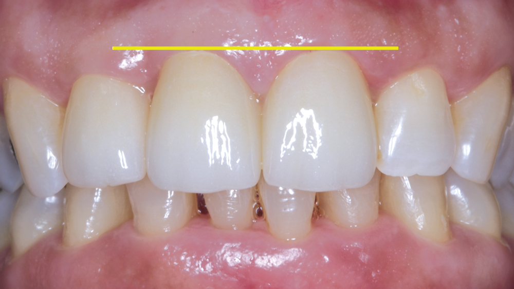 Figure 21: Post-cementation, we can see how the soft tissue now has an ideal symmetry. There is correct parallelism of the gingival line and the incisal edge position.