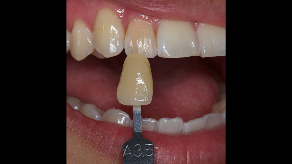 photo showing the difference in shade between tooth #7 and #8.