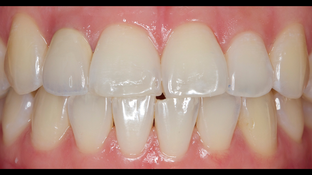 restored teeth