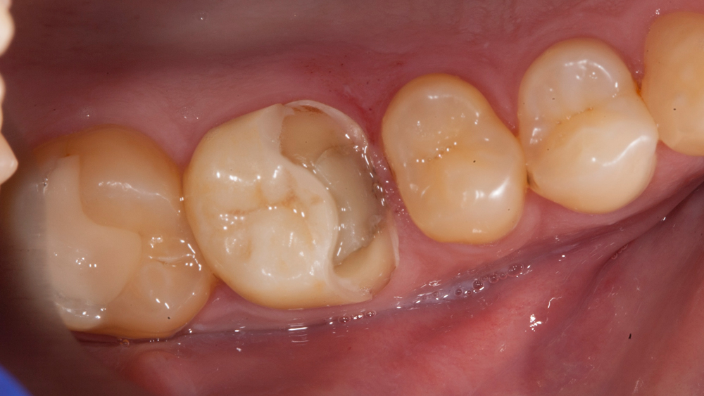 picture of an  existing, fractured restoration on tooth #14.