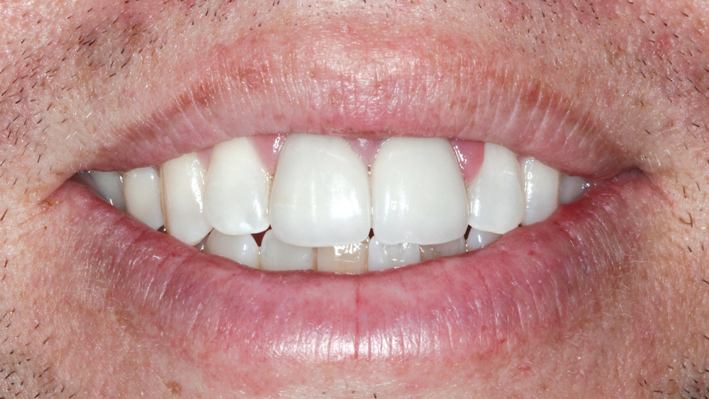 Figures 3a: These images show the smile progression of the patient. His at-rest state demonstrates lip incompetence. Complicating the esthetics further, a significant portion of the gingiva becomes visible as the mouth progresses from partial to full smile.