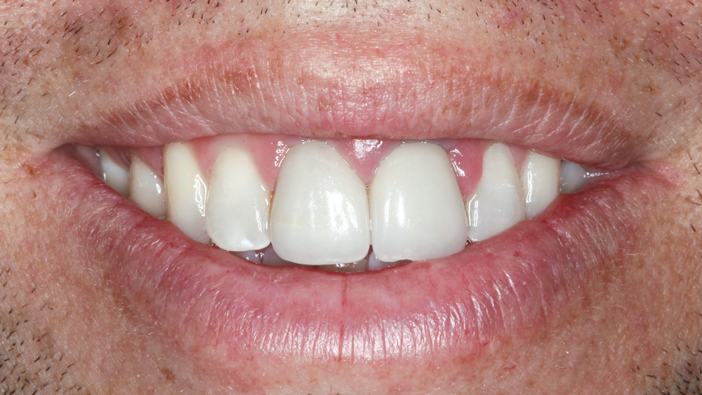 Figures 3b: These images show the smile progression of the patient. His at-rest state demonstrates lip incompetence. Complicating the esthetics further, a significant portion of the gingiva becomes visible as the mouth progresses from partial to full smile.