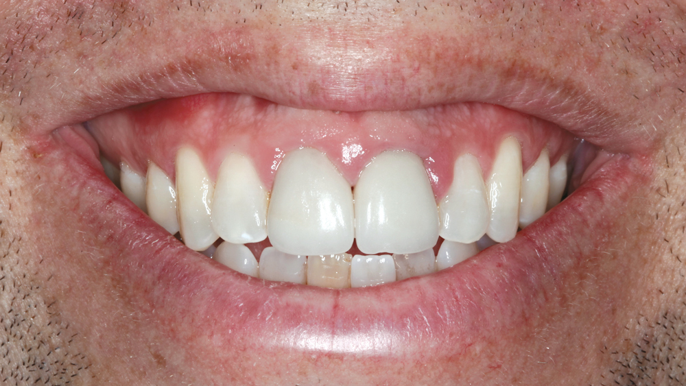 Figures 3c: These images show the smile progression of the patient. His at-rest state demonstrates lip incompetence. Complicating the esthetics further, a significant portion of the gingiva becomes visible as the mouth progresses from partial to full smile.