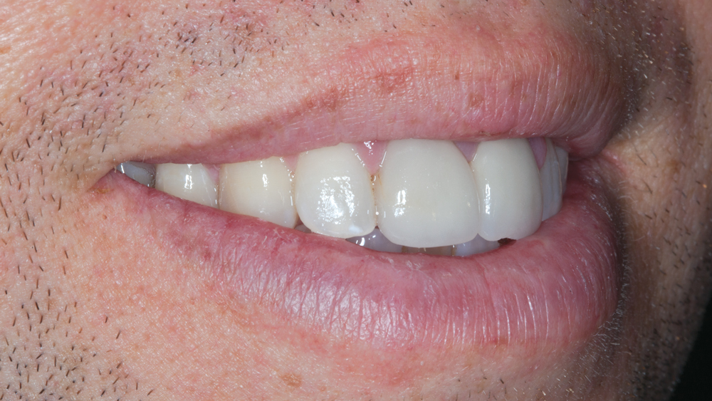 Figures 4a: The over-contoured existing all-ceramic crowns are exhibited during examination of the smile progression. The patient’s lip movement presents an esthetic challenge due to the high smile line.