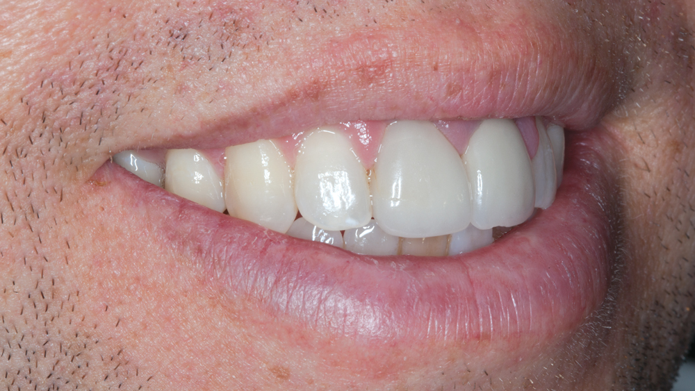 Figures 4b: The over-contoured existing all-ceramic crowns are exhibited during examination of the smile progression. The patient’s lip movement presents an esthetic challenge due to the high smile line.